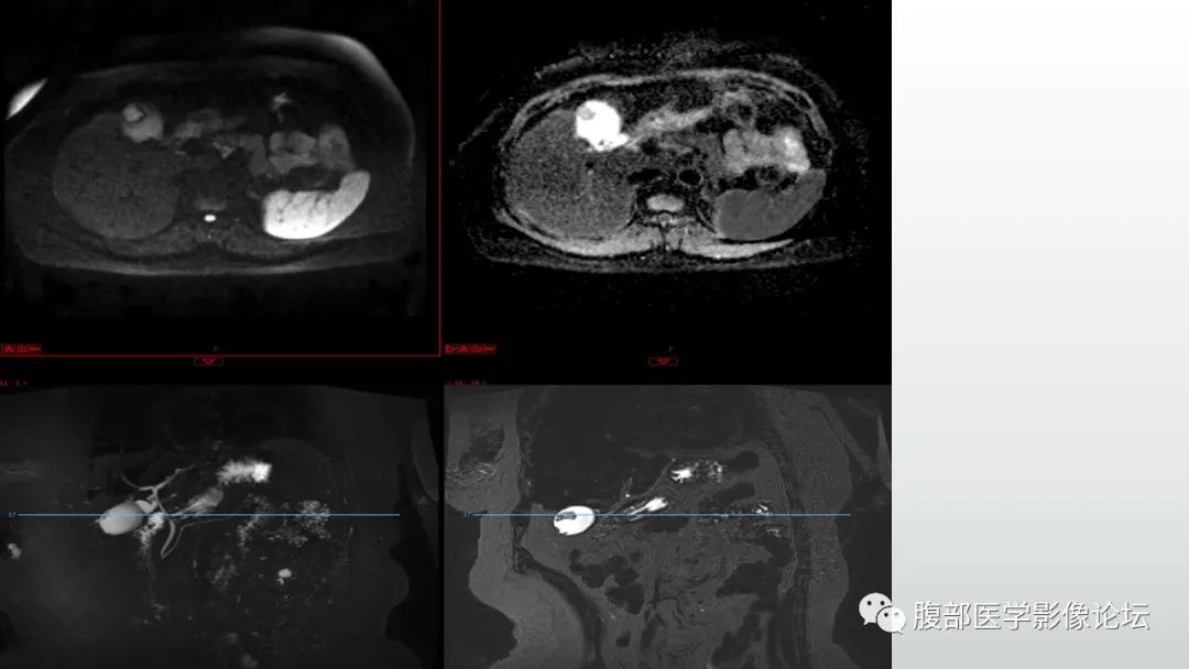 【病例】胆囊管状腺瘤1例CT及MR影像表现-6