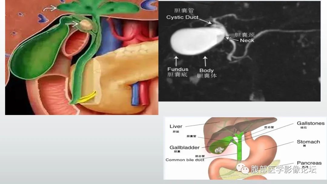 【病例】胆囊管状腺瘤1例CT及MR影像表现-10
