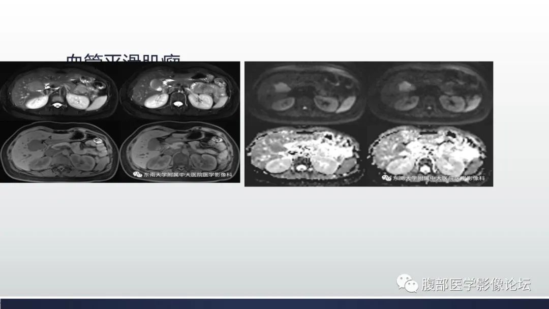 【病例】胆囊管状腺瘤1例CT及MR影像表现-15