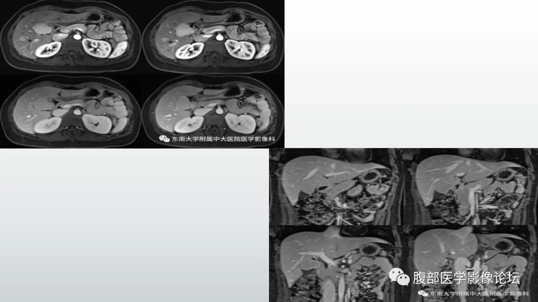 【病例】胆囊管状腺瘤1例CT及MR影像表现-16