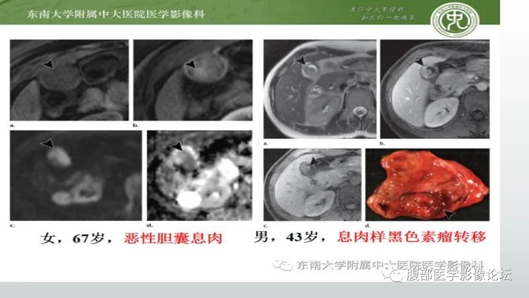 【病例】胆囊管状腺瘤1例CT及MR影像表现-18