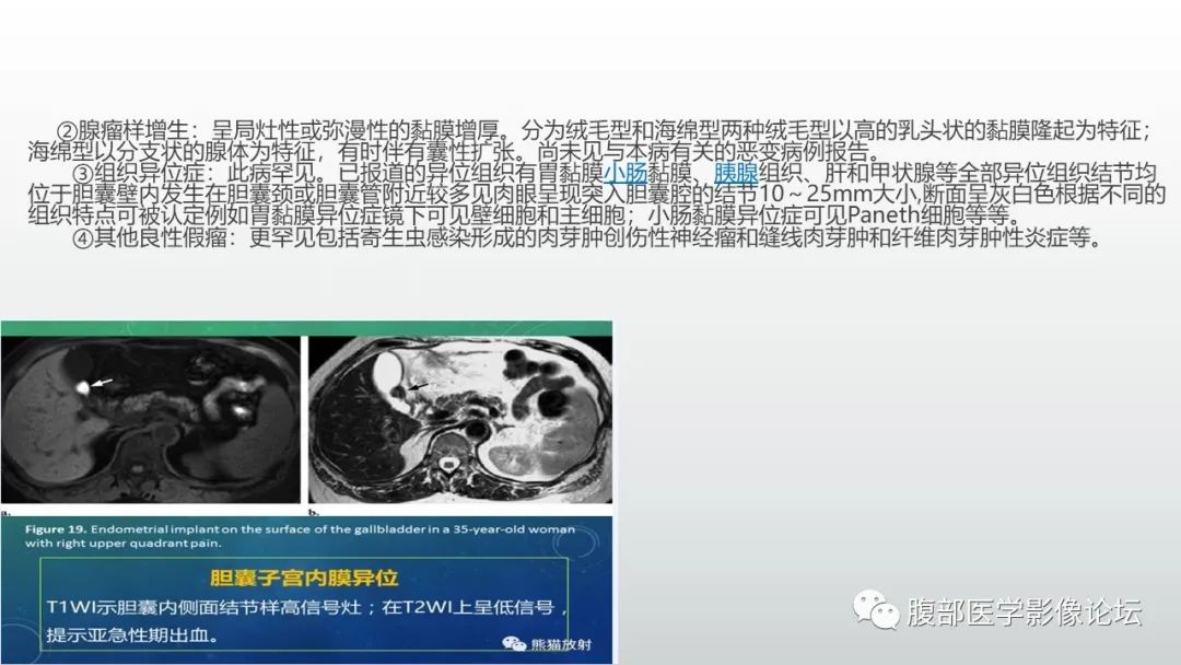 【病例】胆囊管状腺瘤1例CT及MR影像表现-20