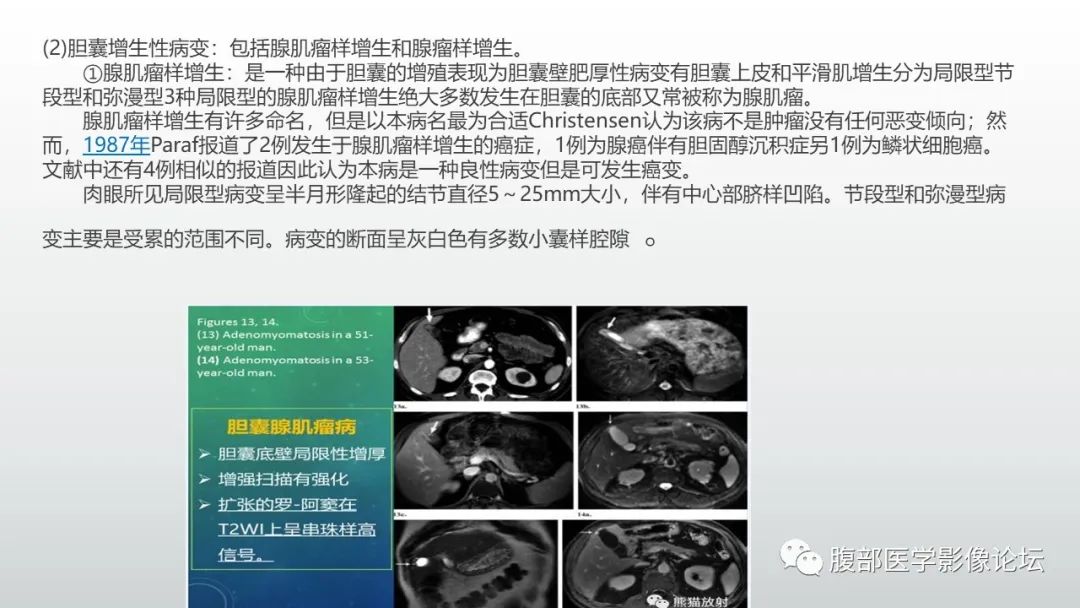 【病例】胆囊管状腺瘤1例CT及MR影像表现-19