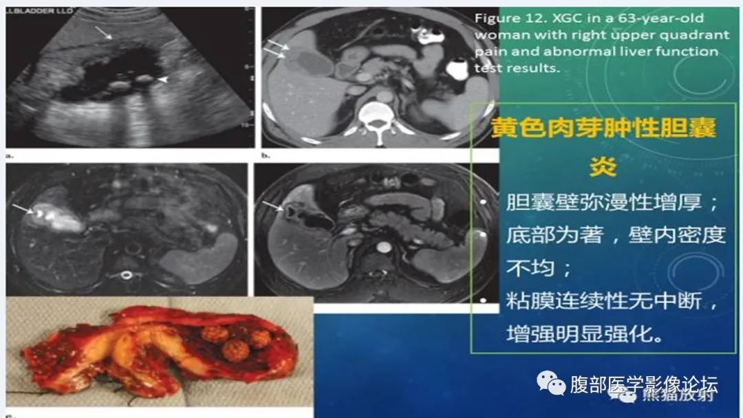 【病例】胆囊管状腺瘤1例CT及MR影像表现-21