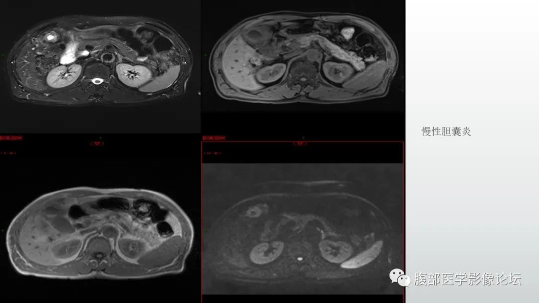 【病例】胆囊管状腺瘤1例CT及MR影像表现-22