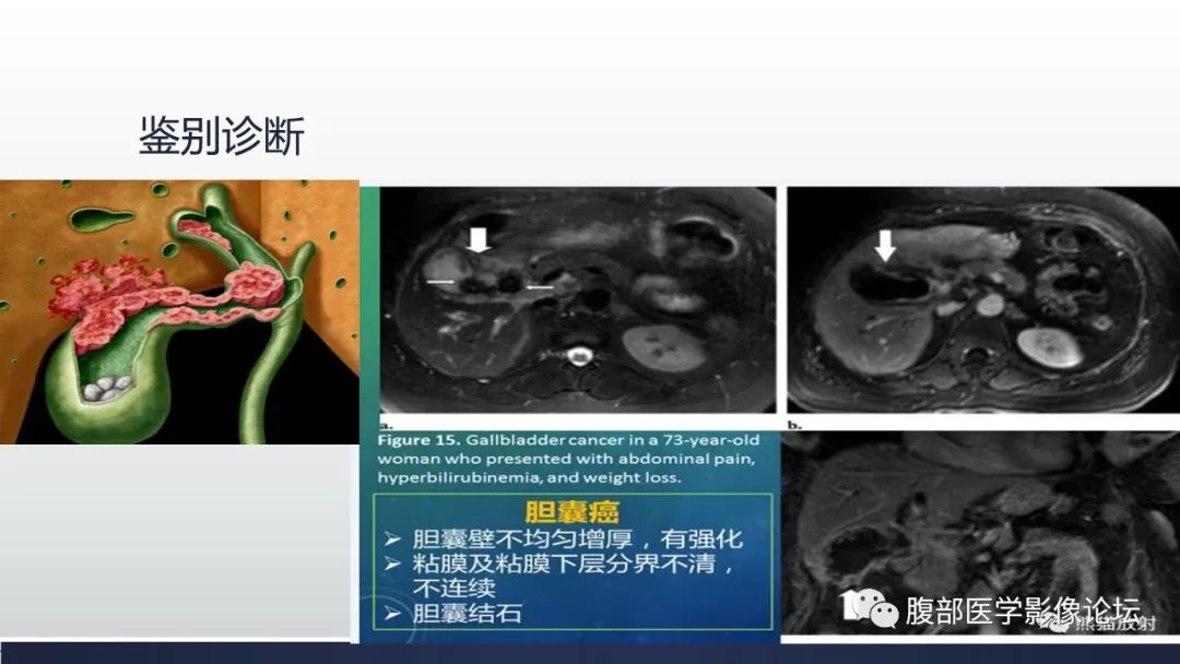 【病例】胆囊管状腺瘤1例CT及MR影像表现-23
