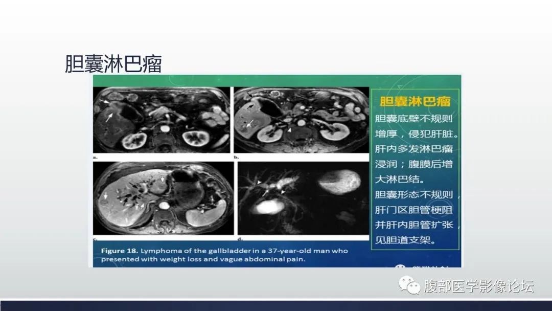 【病例】胆囊管状腺瘤1例CT及MR影像表现-24