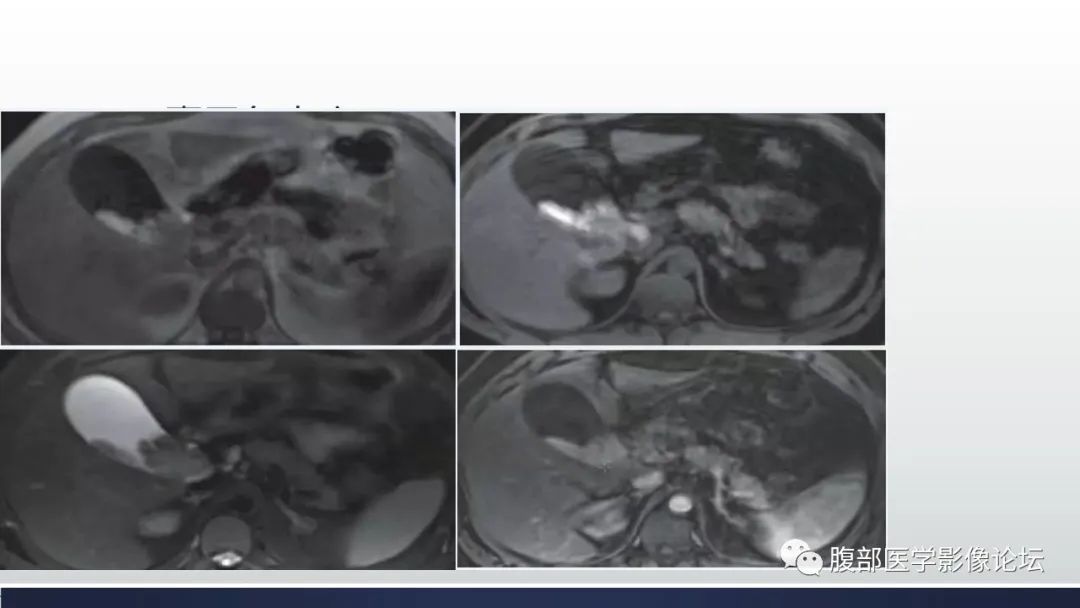 【病例】胆囊管状腺瘤1例CT及MR影像表现-25