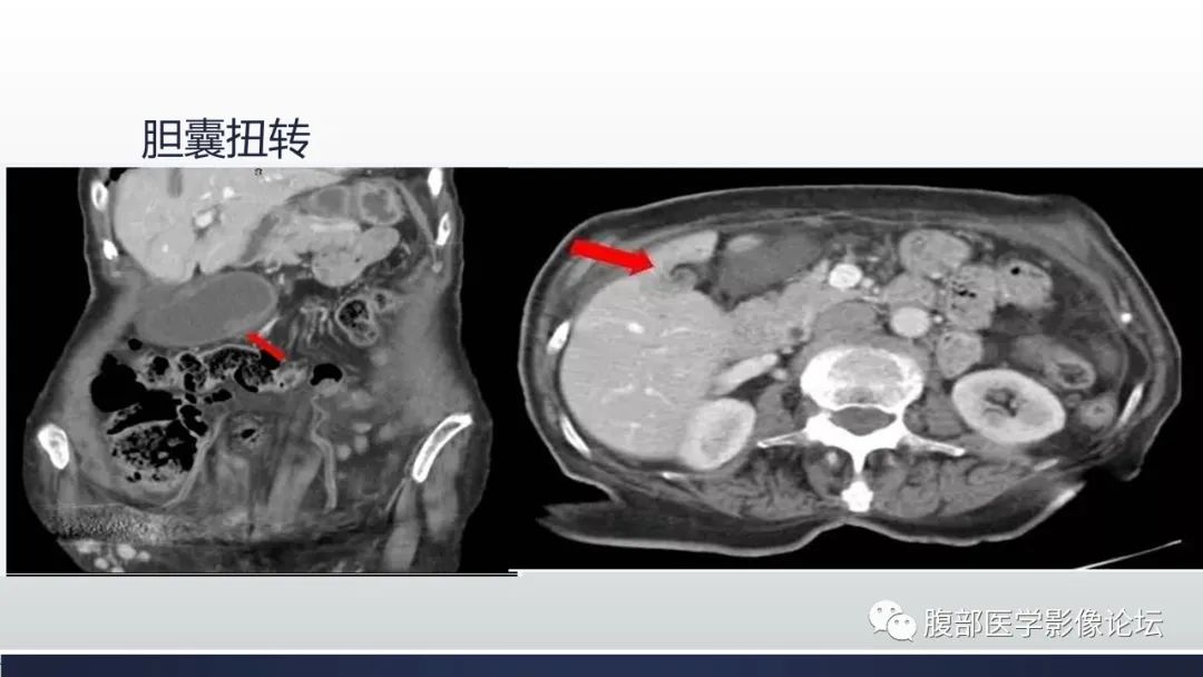 【病例】胆囊管状腺瘤1例CT及MR影像表现-26