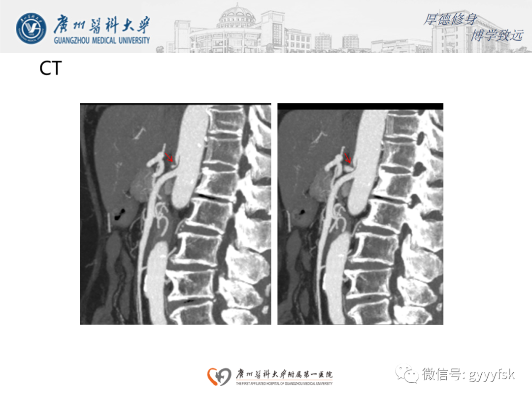 【病例】正中弓状韧带压迫综合征1例CT影像-4