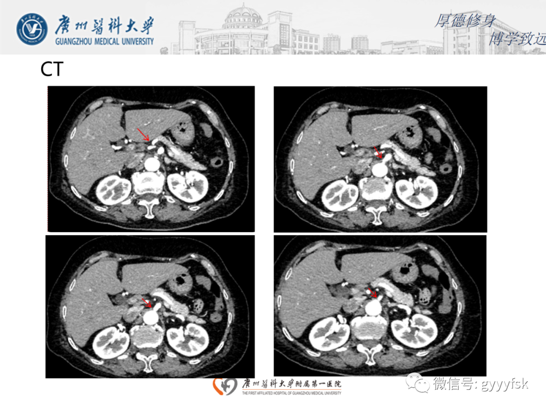 【病例】正中弓状韧带压迫综合征1例CT影像-3