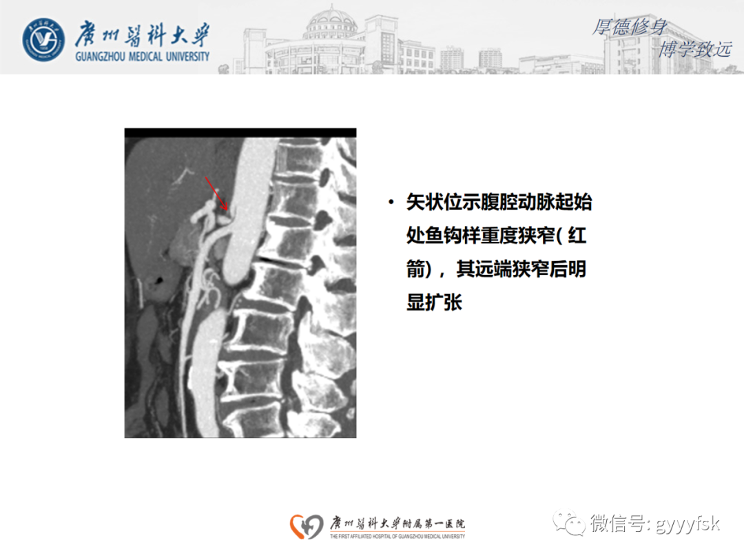 【病例】正中弓状韧带压迫综合征1例CT影像-11