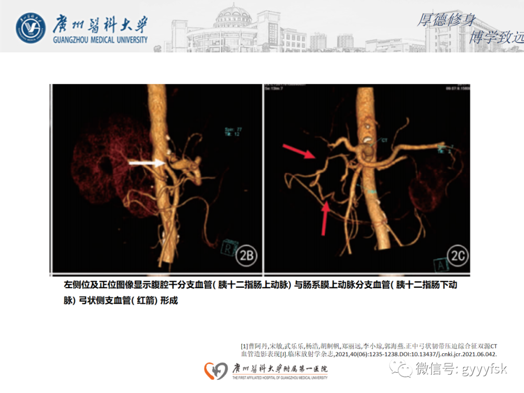 【病例】正中弓状韧带压迫综合征1例CT影像-12