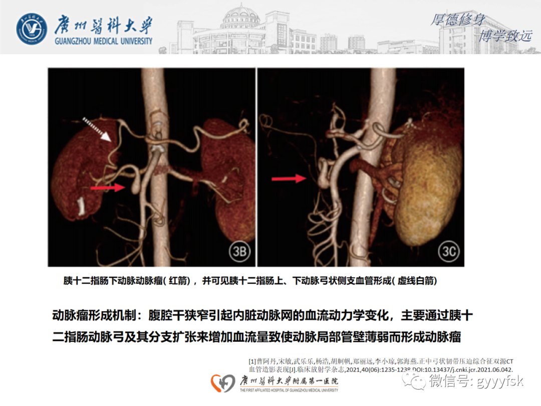 【病例】正中弓状韧带压迫综合征1例CT影像-13