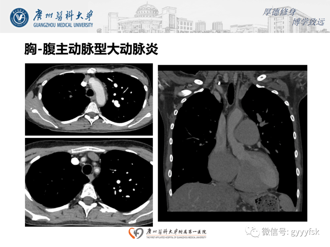 【病例】正中弓状韧带压迫综合征1例CT影像-17