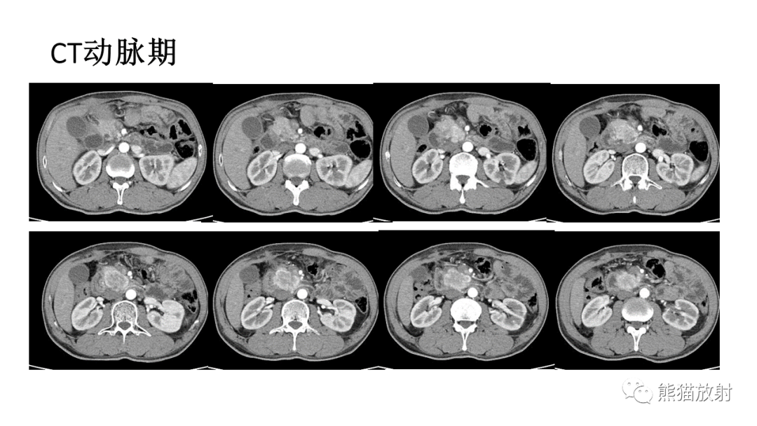 【病例】胰腺神经内分泌肿瘤2例CT及MR影像-5