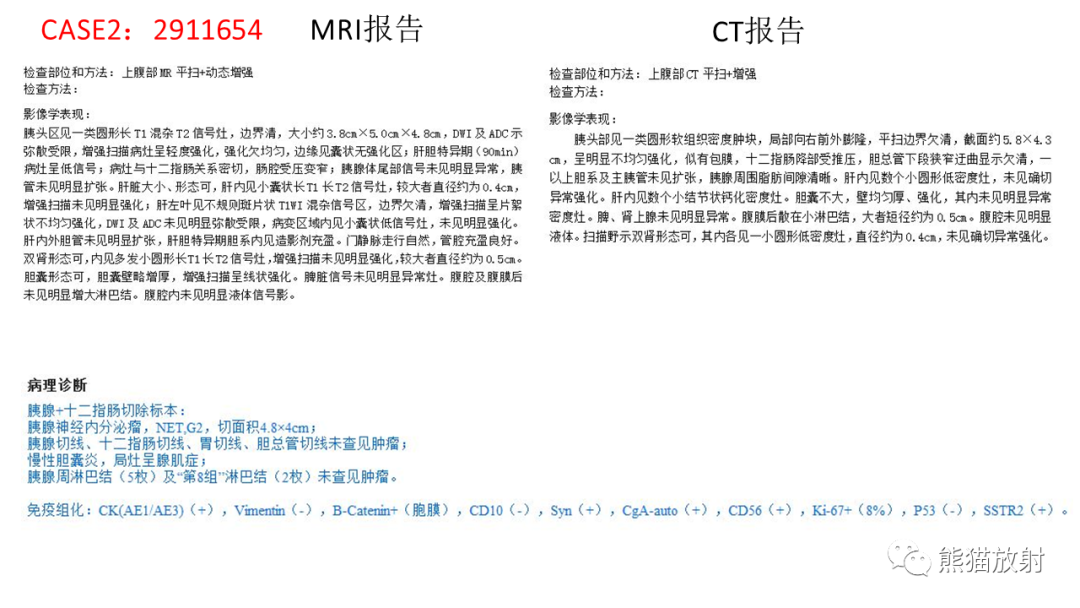 【病例】胰腺神经内分泌肿瘤2例CT及MR影像-17