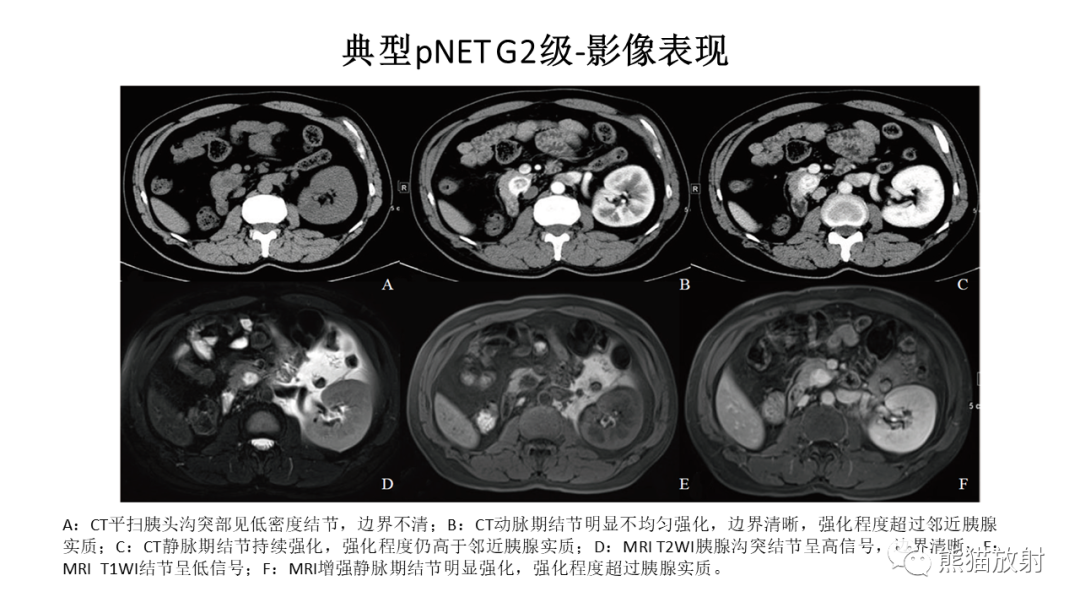 【病例】胰腺神经内分泌肿瘤2例CT及MR影像-26