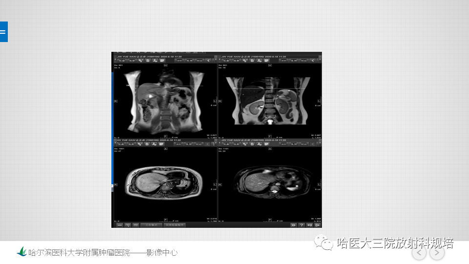 【PPT】肝脏扫描规范及常见问题-12