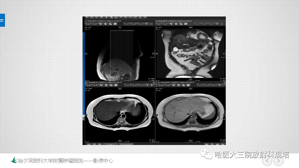 【PPT】肝脏扫描规范及常见问题-14