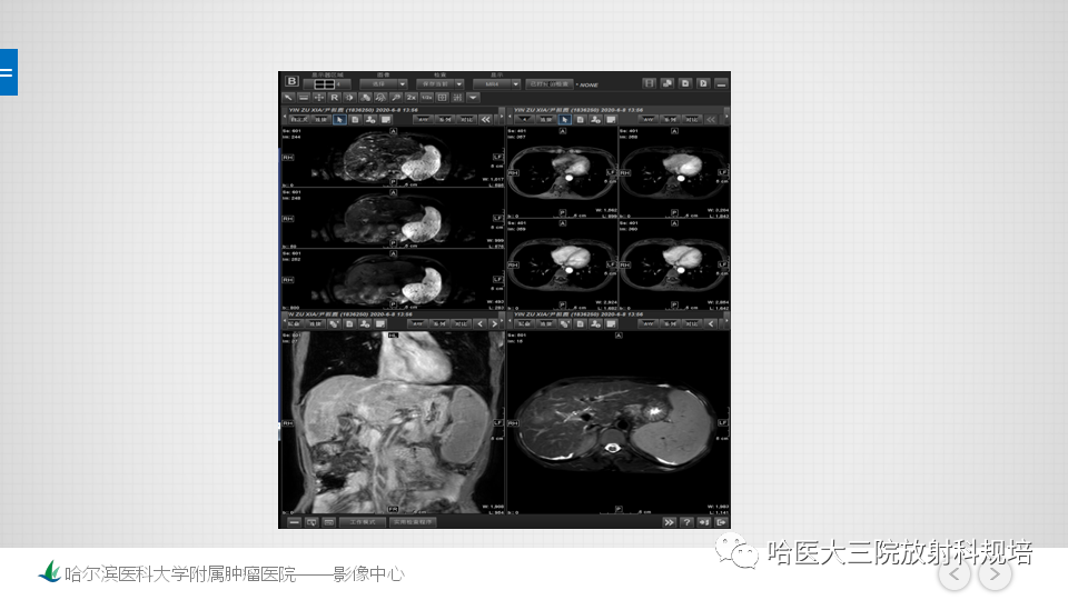 【PPT】肝脏扫描规范及常见问题-21