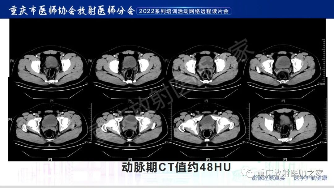 【病例】腺性膀胱炎1例CT影像-4