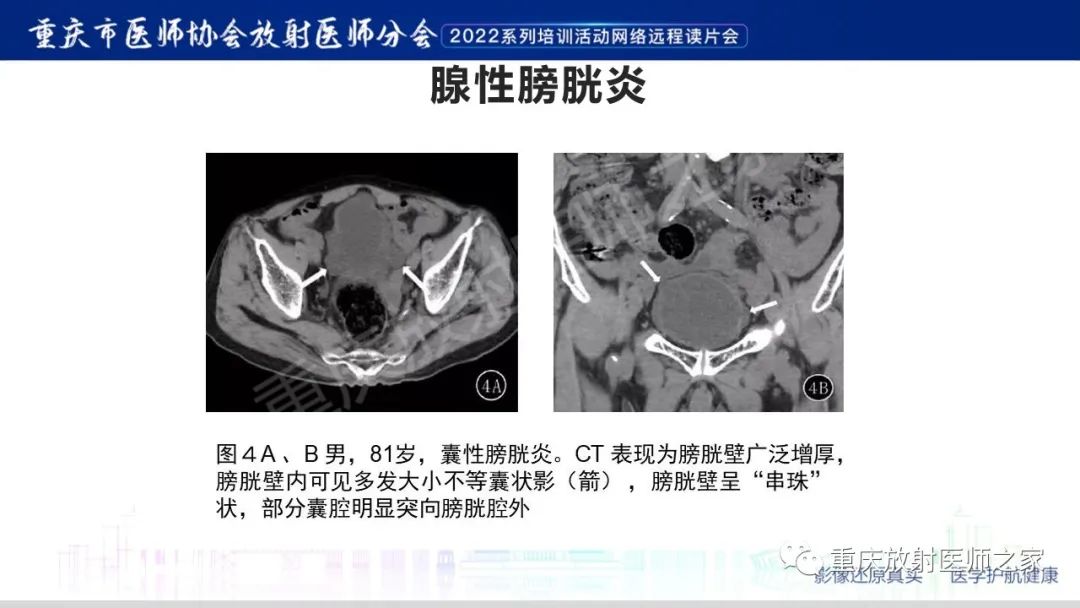 【病例】腺性膀胱炎1例CT影像-19
