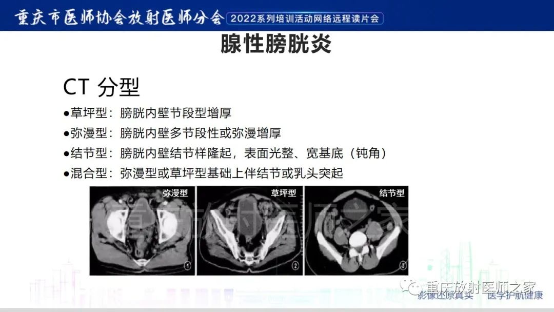 【病例】腺性膀胱炎1例CT影像-17