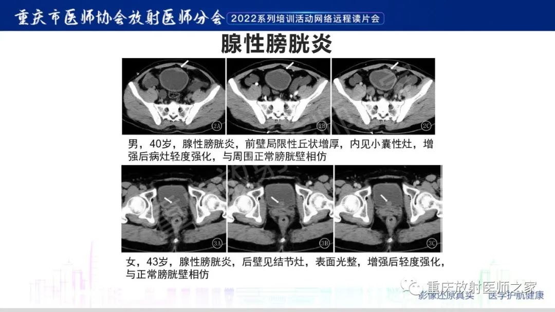 【病例】腺性膀胱炎1例CT影像-18