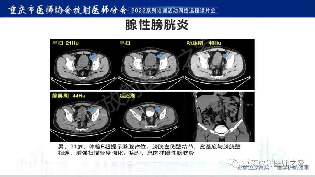 【病例】腺性膀胱炎1例CT影像-21