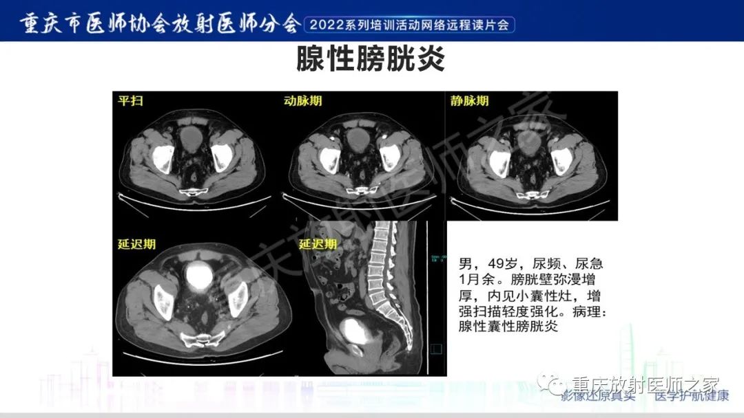 【病例】腺性膀胱炎1例CT影像-22