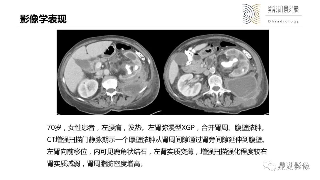 【PPT】黄色肉芽肿性肾盂肾炎-20