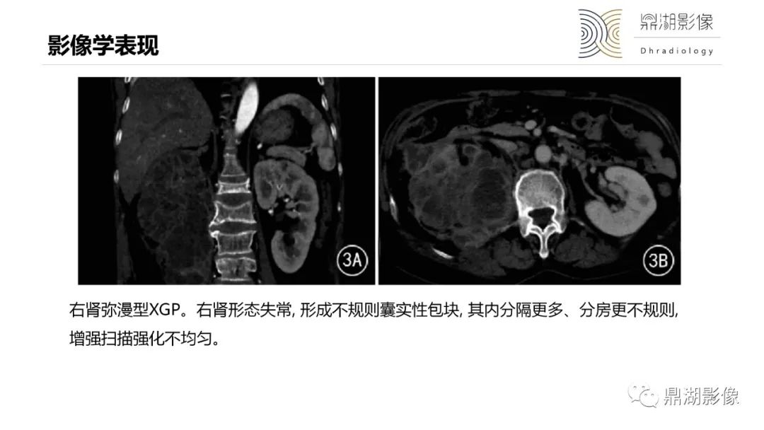 【PPT】黄色肉芽肿性肾盂肾炎-19