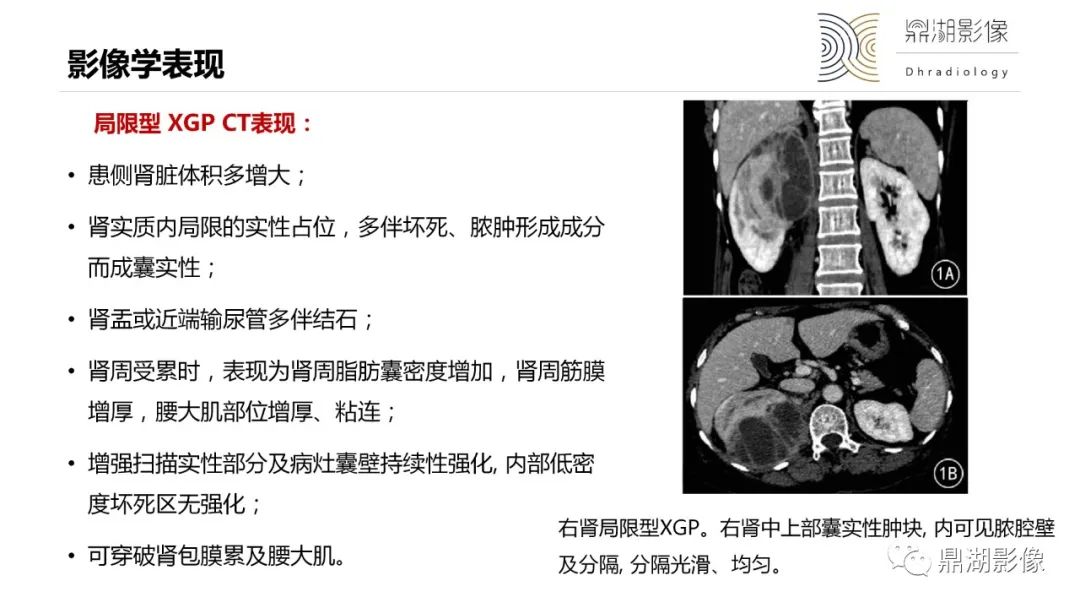 【PPT】黄色肉芽肿性肾盂肾炎-23
