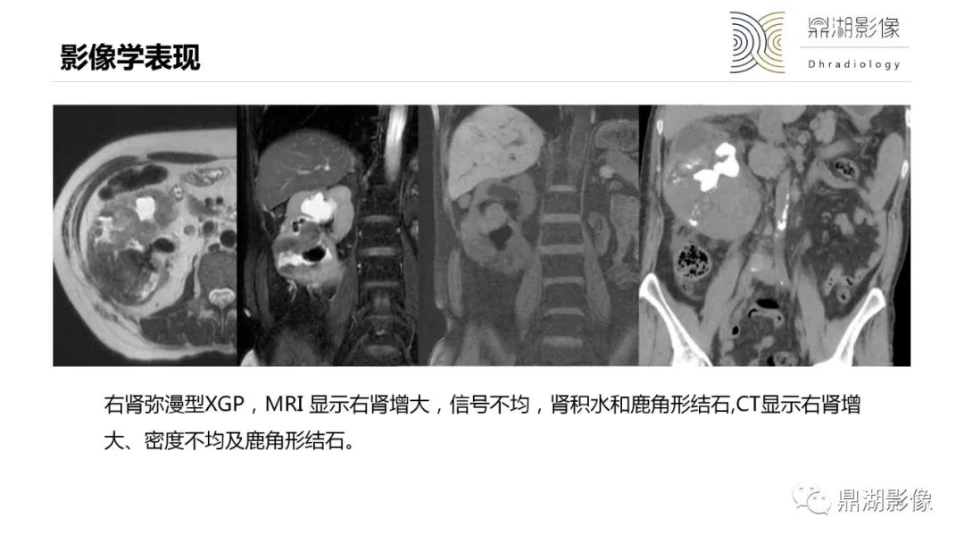 【PPT】黄色肉芽肿性肾盂肾炎-26