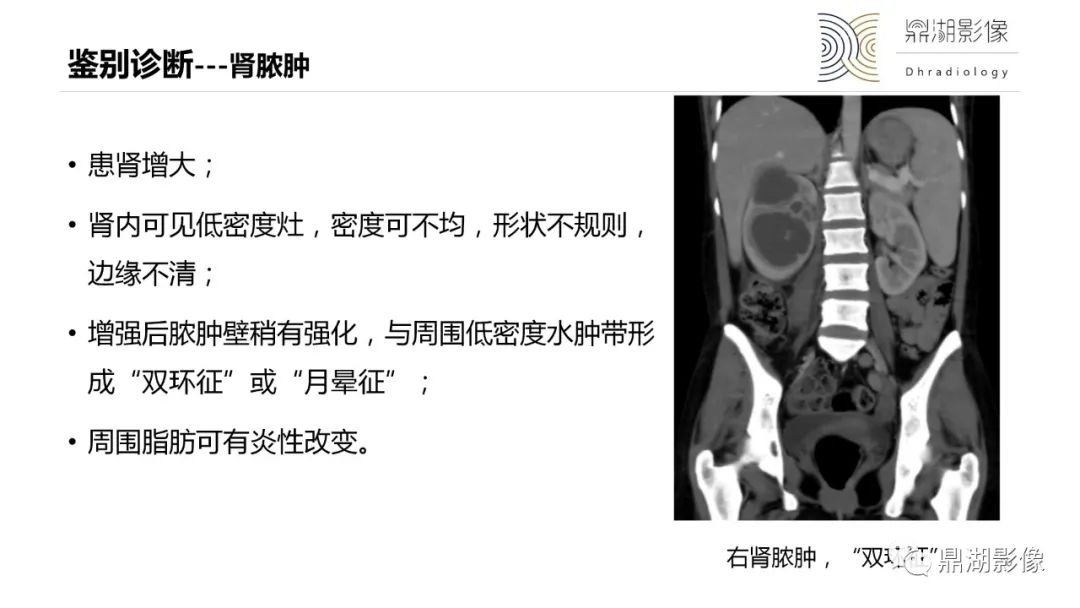 【PPT】黄色肉芽肿性肾盂肾炎-30