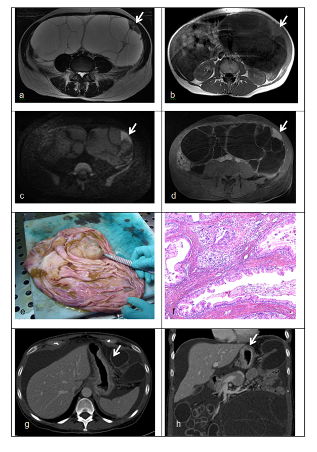 【病例】盆腔肿块，需要考虑到这个来源…-5