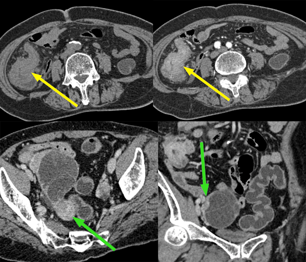 【病例】盆腔肿块，需要考虑到这个来源…-2