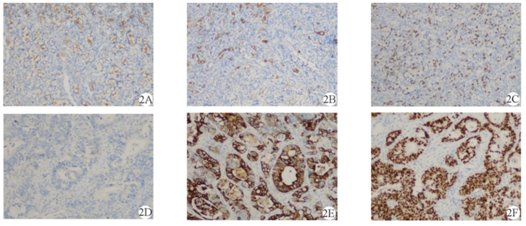 【病例】盆腔肿块，需要考虑到这个来源…-4