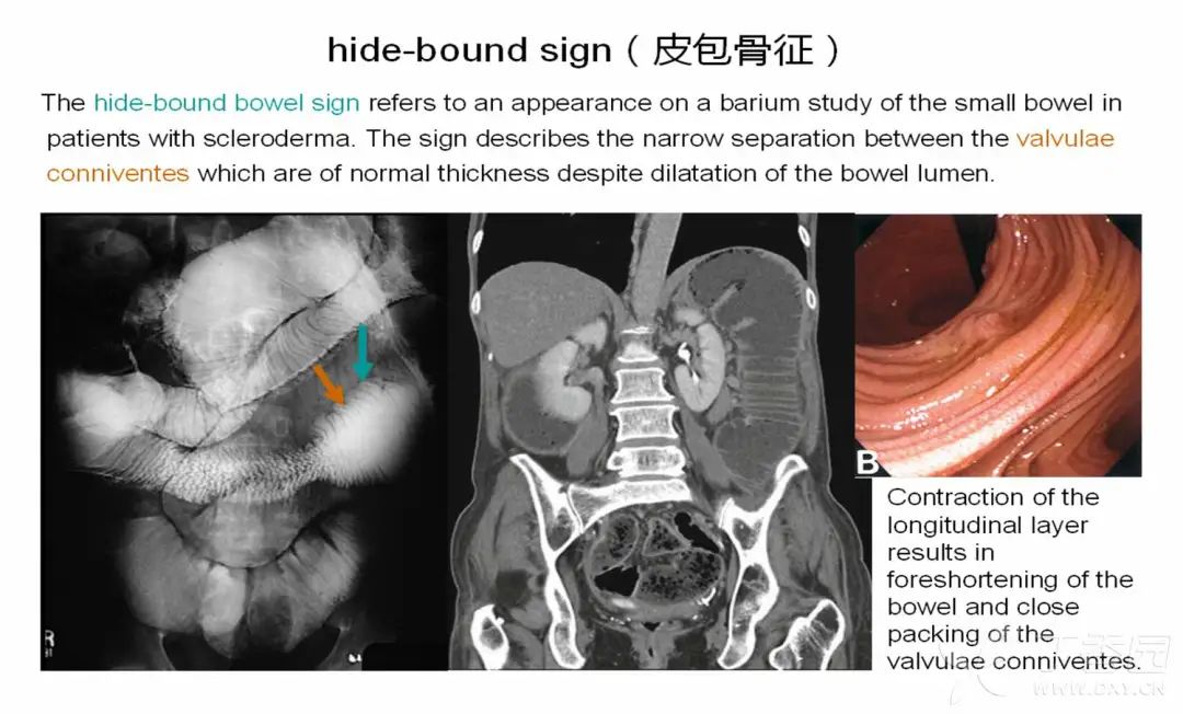 小肠皮包骨征-1