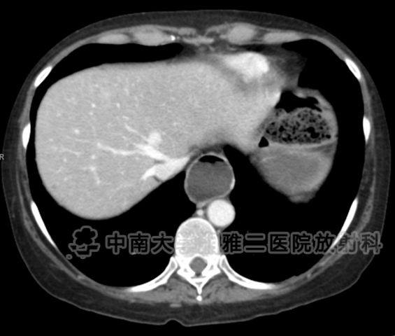 小肠皮包骨征-2