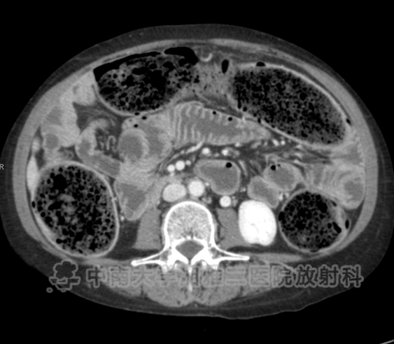 小肠皮包骨征-3