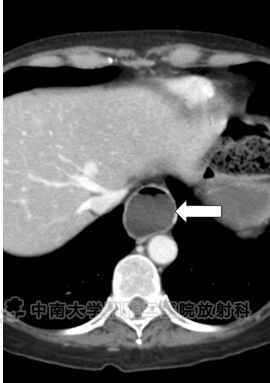 小肠皮包骨征-5