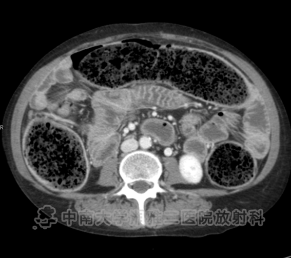 小肠皮包骨征-4