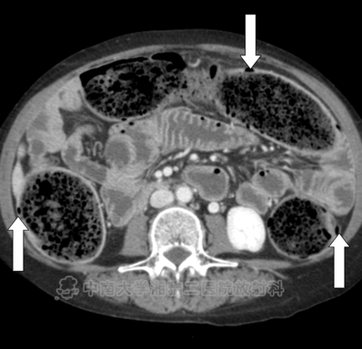 小肠皮包骨征-6