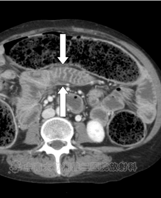 小肠皮包骨征-7