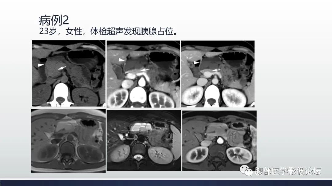 【病例】胰腺血管瘤1例CT及MR影像-2