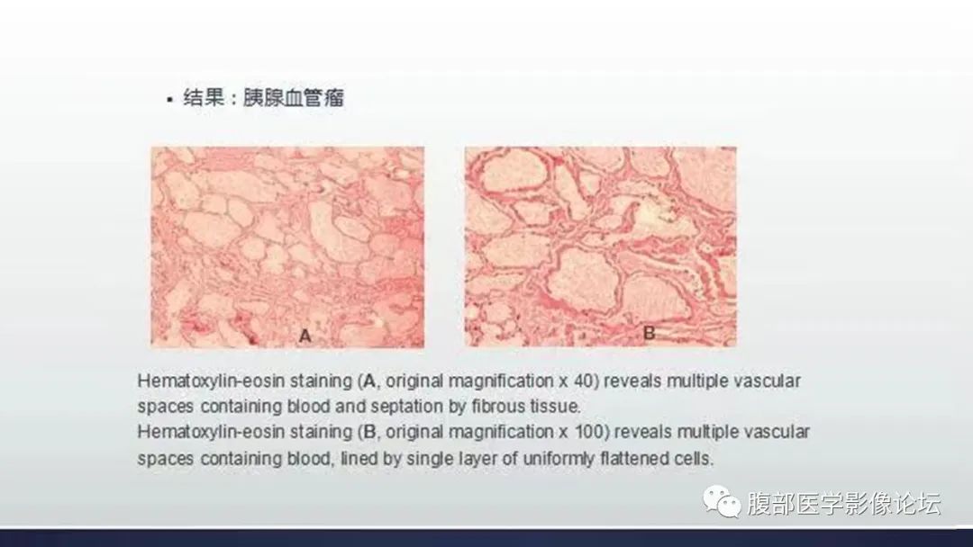 【病例】胰腺血管瘤1例CT及MR影像-3