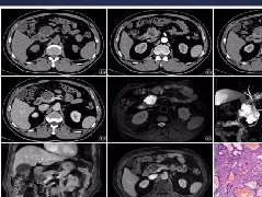 胰腺血管瘤1例CT及MR影像