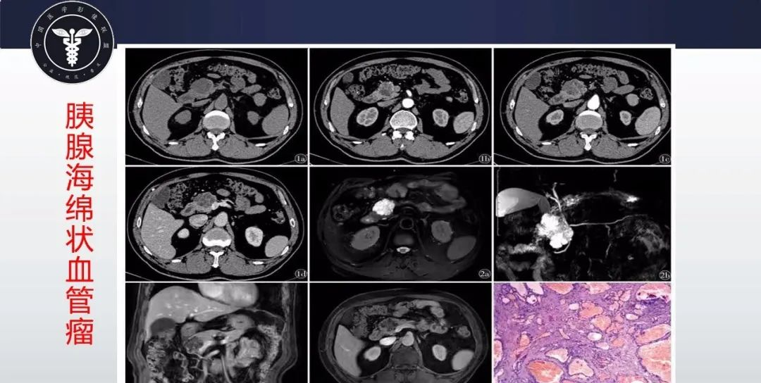 【病例】胰腺血管瘤1例CT及MR影像-6